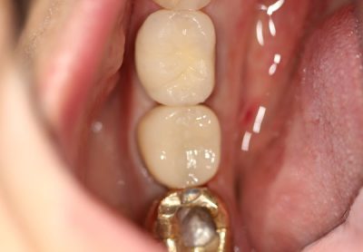 Before and After Photos - After Treatment - CEREC Crown