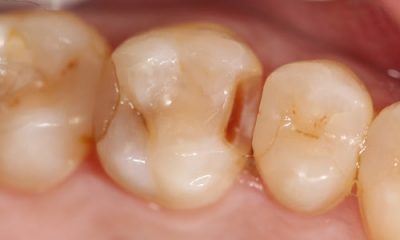 Before and After Photos - Before Treatment - CEREC Crown