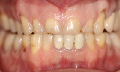 Before and After Photos - Before Treatment - Full Smile Makeover