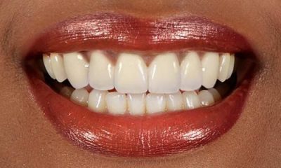 Before and After Photos - After Treatment - Veneers
