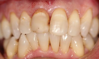 Before and After Photos - Before Treatment - Veneers