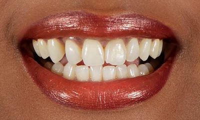 Before and After Photos - Before Treatment - Veneers