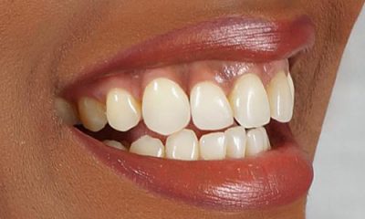 Before and After Photos - After Treatment - Veneers