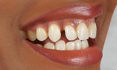 Before and After Photos - Before Treatment - Veneers