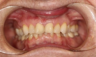 Before and After Photos - Before Treatment - Veneer