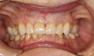 Before and After Photos - After Treatment - Veneer