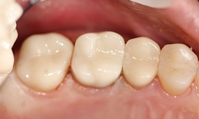 Before and After Photos - After Treatment - Cerec