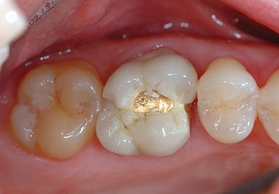 Before and After Photos - Before Treatment - Dental Crown