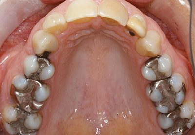 Before and After Photos - Before Treatment - Multiple Teeth Replacement