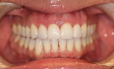 Before and After Photos - After Treatment - Veneers