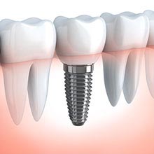 Dental Implants