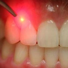 Laser Gum Surgery