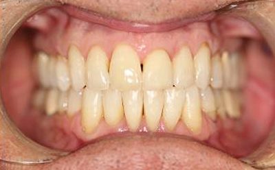 Before and After Photos - After Treatment - Invisalign