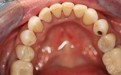 Before and After Photos - After Treatment - Invisalign