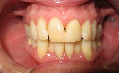 Before and After Photos - Before Treatment - Invisalign